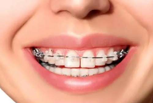 纯钛烤瓷牙——美丽牙齿的投资值得吗？