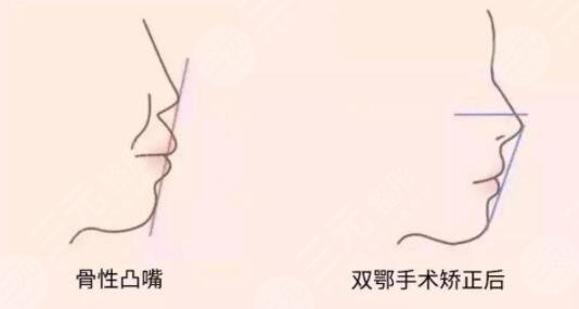 正颌手术