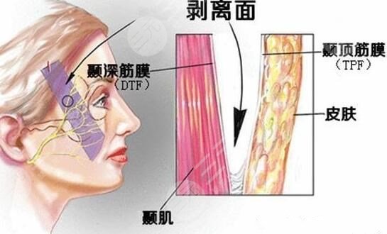 冰电波拉皮的功效与作用是什么?
