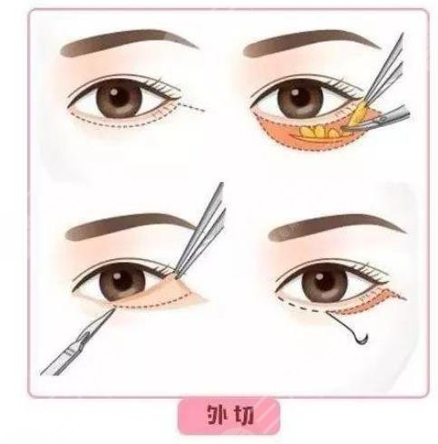 外切眼袋手术恢复期要多久