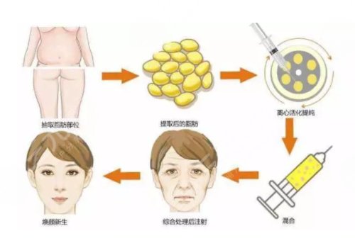 面部脂肪填充能保持几年？