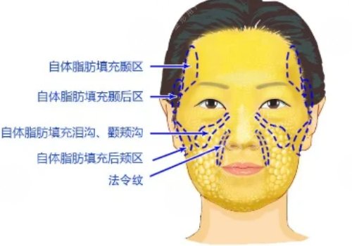 面部脂肪填充能保持几年？