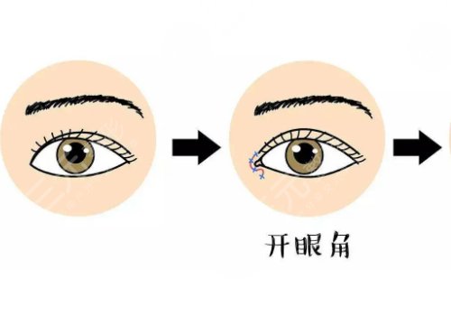 内眼角开大了修复案例图