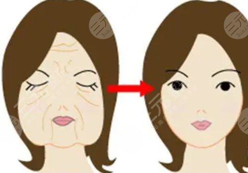 电波拉皮项目和热玛吉项目的区别