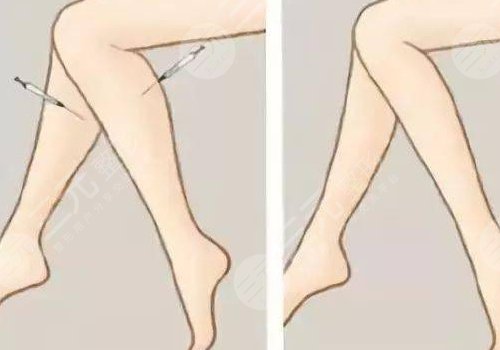 怎么快速瘦小腿？