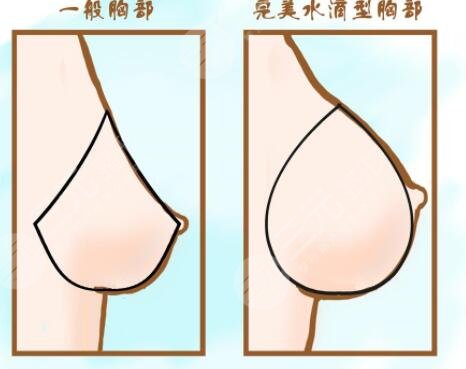在做完闪耀假体隆胸之后需要注意什么?