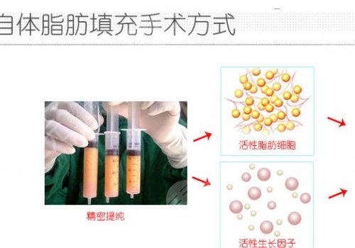 自体脂肪面部填充能保持多久？