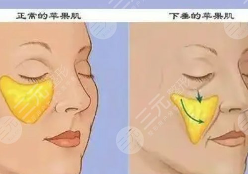 面颊凹陷怎么恢复饱满？