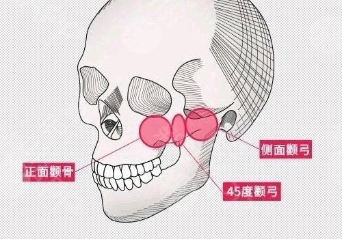 颧骨内推风险高吗？多少钱？