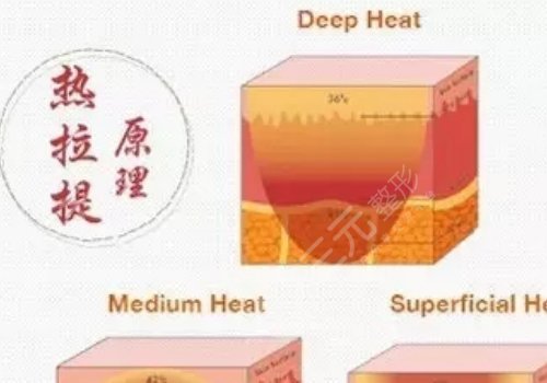 热拉提plus做一次可以维持多久？