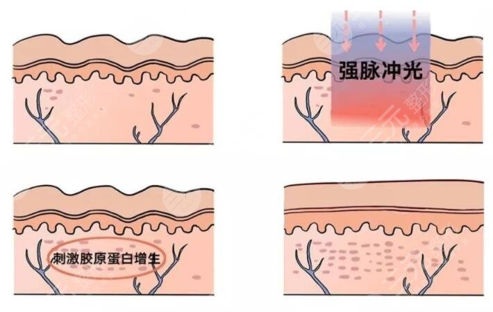 光子嫩肤的缺点