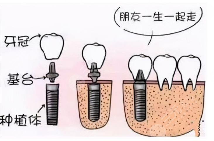 种植牙的五大危害