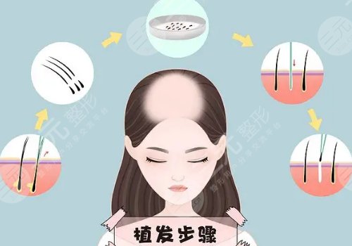 纹发和植发哪个效果好？