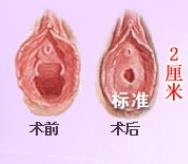处女磨修复