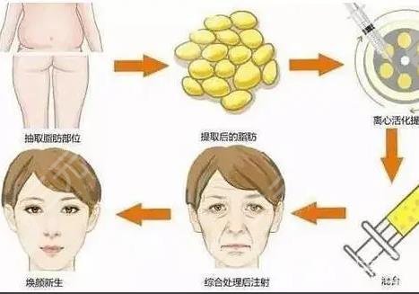 填充太阳凹陷脂肪能保持多久?
