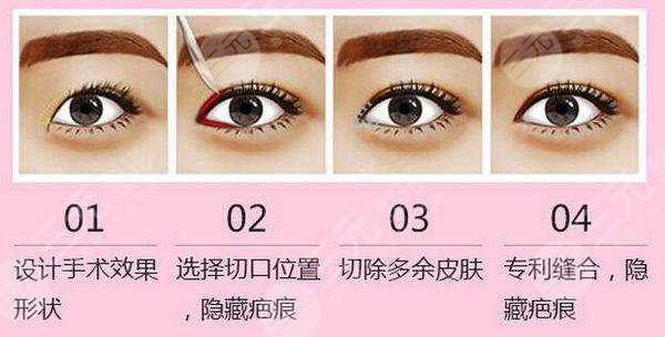 开眼角会让眼睛变大吗?