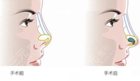 膨体隆鼻的副作用有哪些?