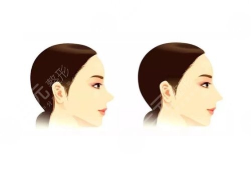 胶原蛋白隆鼻的优缺点有哪些?