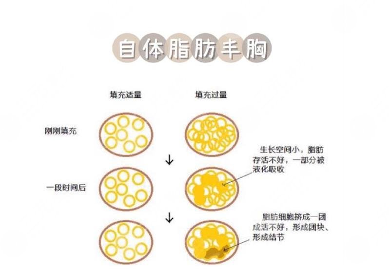)纤维结节