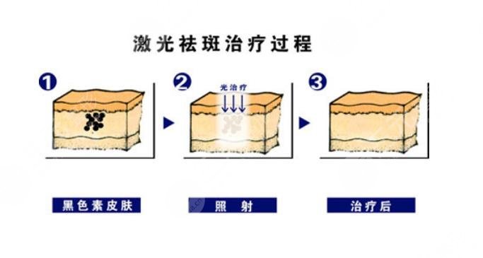 怎样祛斑果好些?