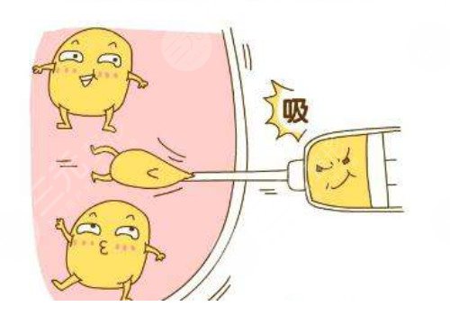 光纤溶脂和吸脂哪个果好?