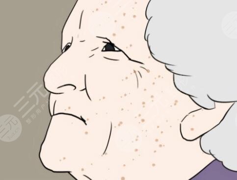 怎样去除老年斑?