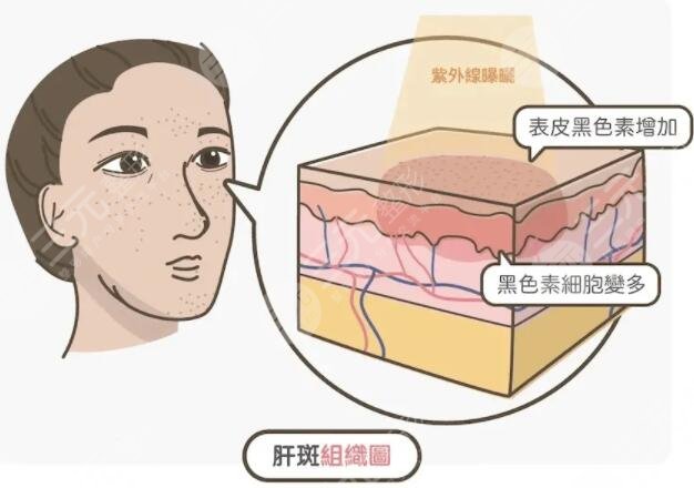 脸上斑点形成的原因