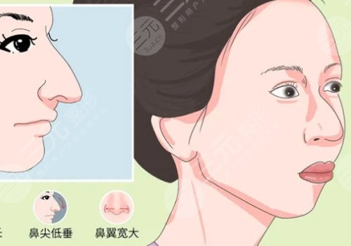 驼峰鼻整形的价格是多少?