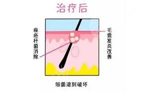 红光治疗痤疮果怎样?