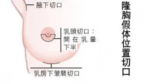 塞彬假体