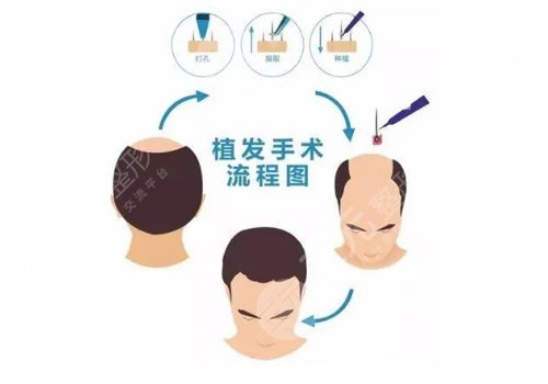 头发种植多少钱一个毛囊？