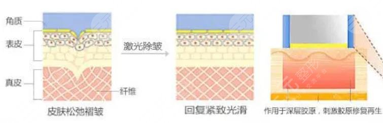 激光除皱